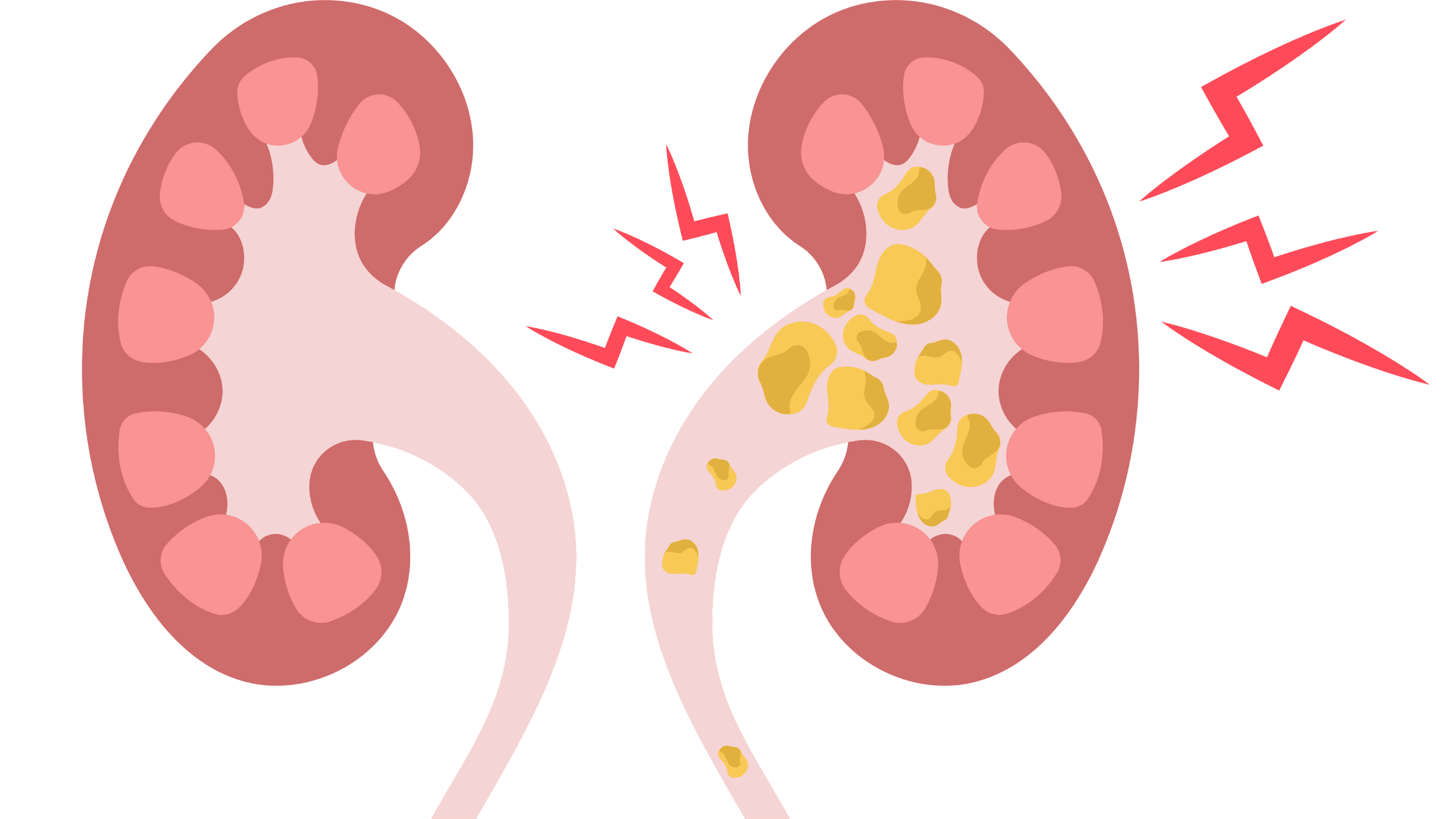 Kidney Disease